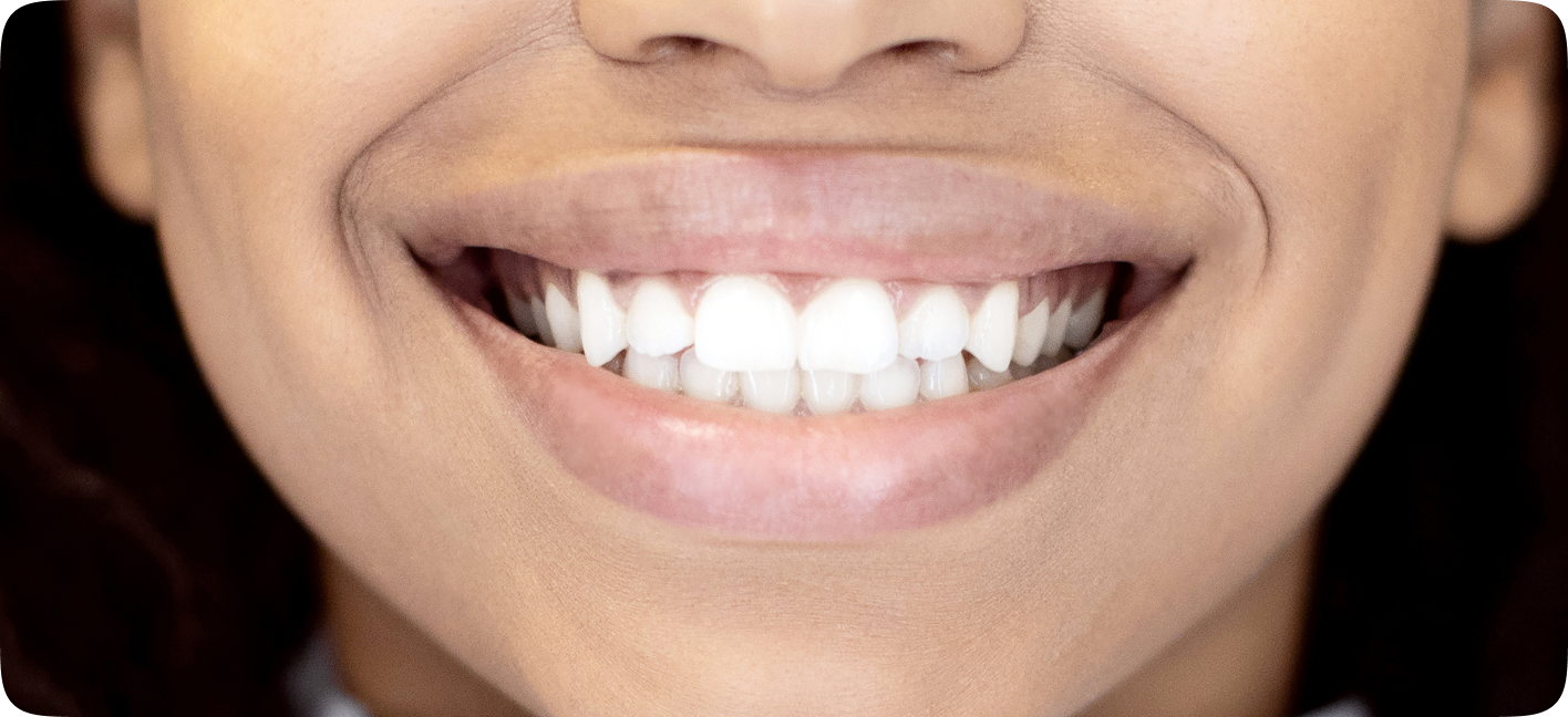 Close de um sorriso com facetas dentárias